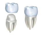 illustration showing how dental crown fits on tooth, dental crowns in Topeka, KS